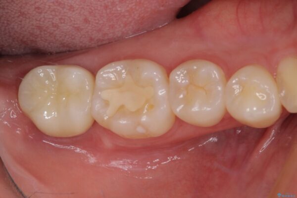 クラウンがすぐに外れてしまう　歯冠長延長術を用いた補綴治療 治療後画像