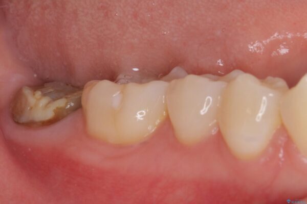 クラウンがすぐに外れてしまう　歯冠長延長術を用いた補綴治療 治療前画像