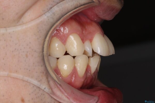下顎骨が顕著に右側にずれている　インビザラインによる咬合改善 治療前画像