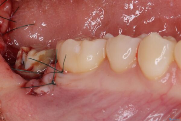 クラウンがすぐに外れてしまう　歯冠長延長術を用いた補綴治療 治療途中画像