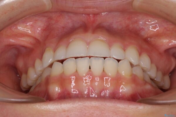 目立ちにくい抜歯矯正　ハーフリンガル 治療後画像