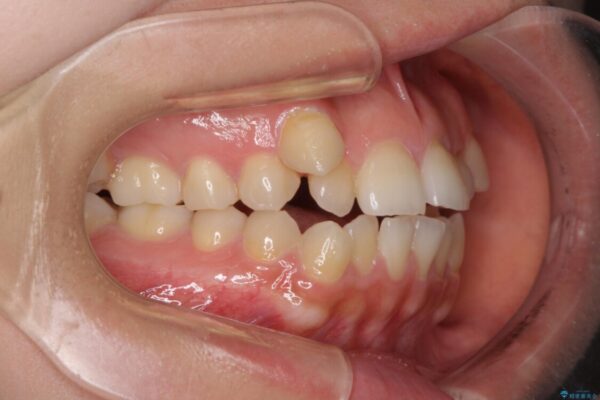 目立ちにくい抜歯矯正　ハーフリンガル 治療前画像