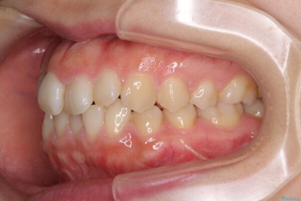 変則的な抜歯矯正　八重歯を抜いてしまった人のワイヤー矯正 治療前画像
