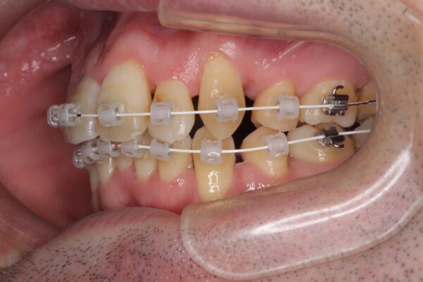 ものが挟まる　著しい叢生を解消　ワイヤー装置による抜歯矯正 治療途中画像