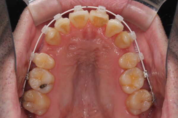 ものが挟まる　著しい叢生を解消　ワイヤー装置による抜歯矯正 治療途中画像