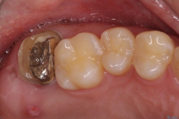 歯に穴を開けられてしまった　インプラントによる奥歯の補綴治療 ビフォー