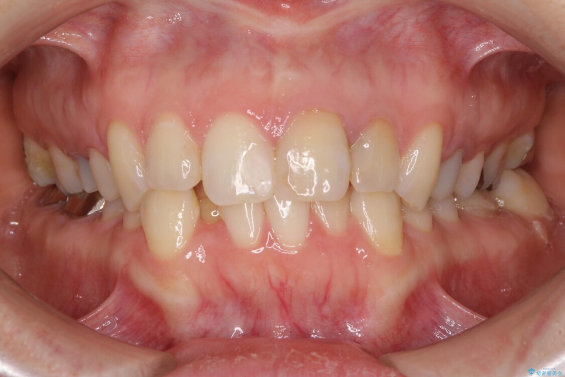 【モニター】前歯のデコボコと奥歯の虫歯　インビザライン治療と奥歯のセラミック治療 治療前