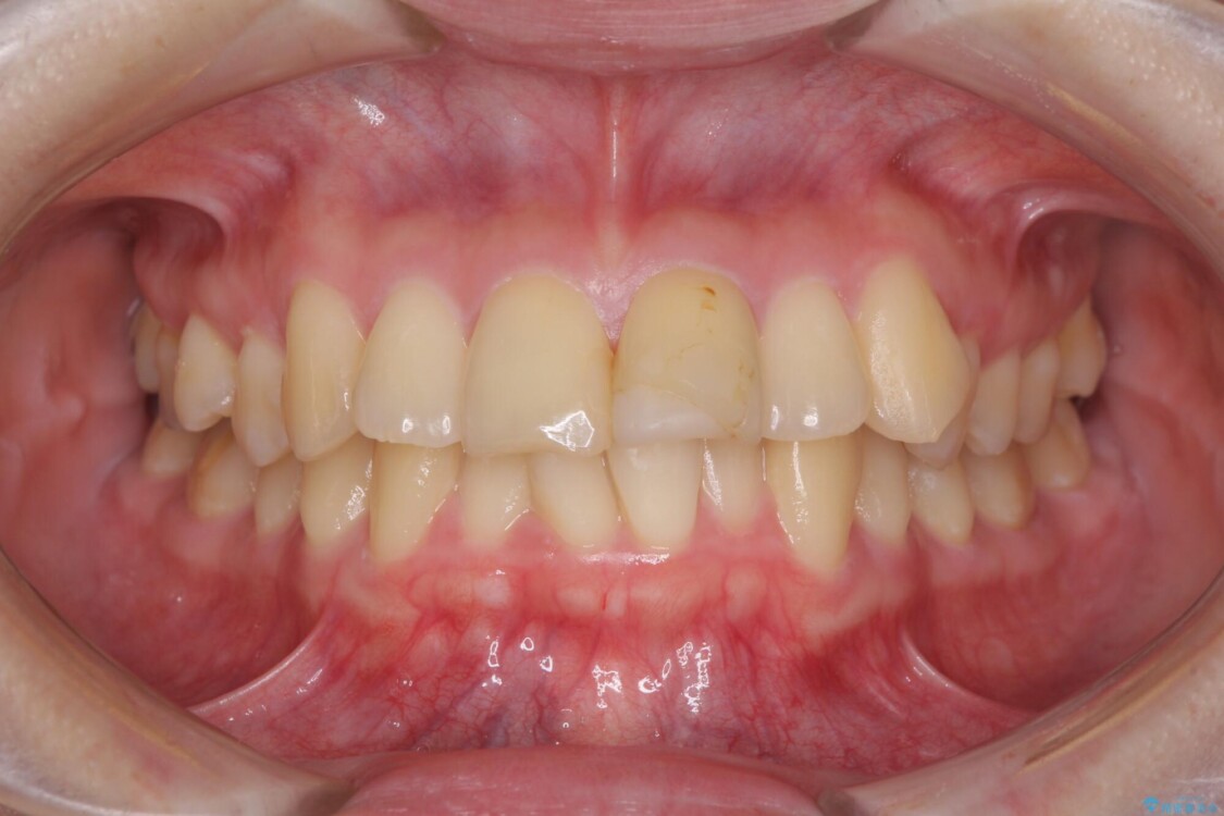 上下前歯のデコボコをきれいに　インビザラインによる矯正治療 治療前