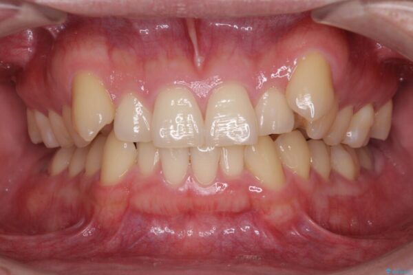 気になる八重歯を抜歯矯正で改善　補助装置を用いたインビザライン矯正 治療前画像