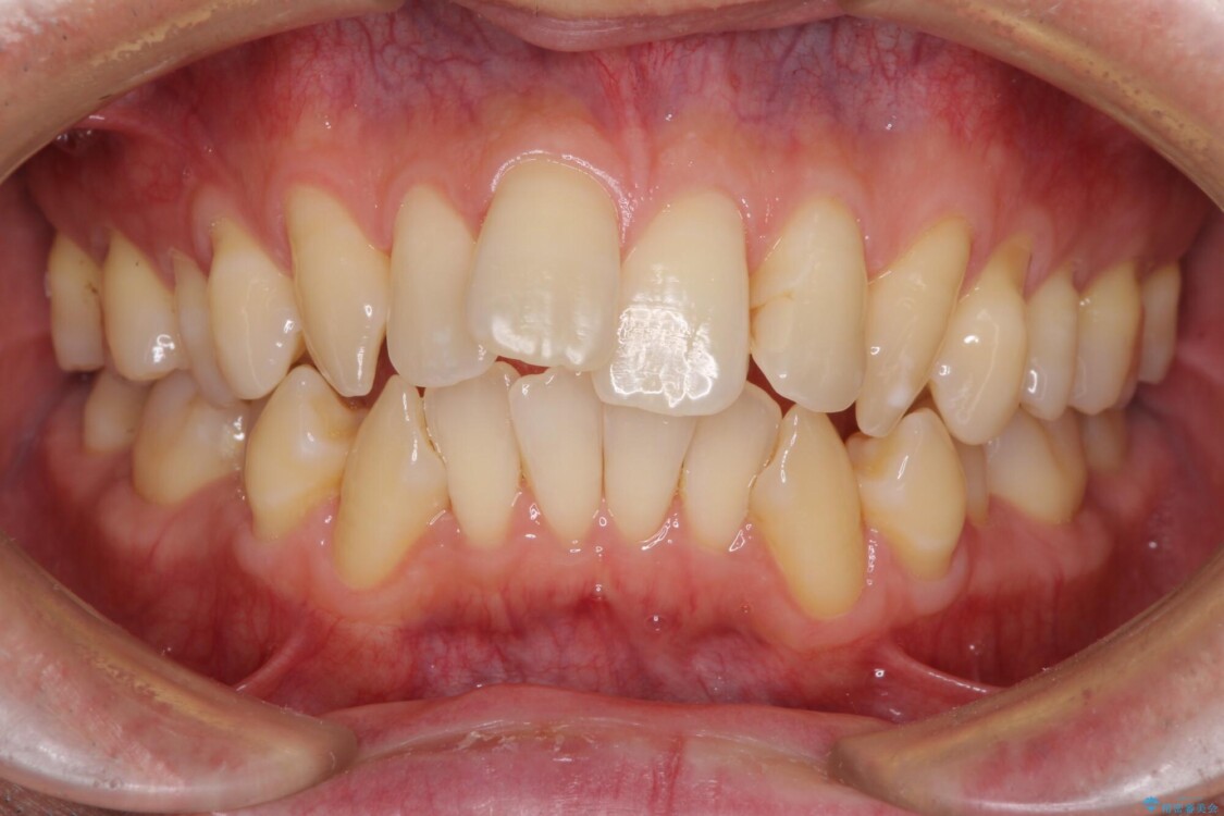 掃除しにくい前歯と閉じにくい口元　目立たないワイヤー装置での抜歯矯正 治療前