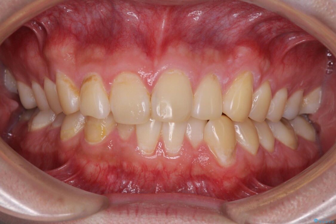 気になる前歯を治したい　短期間でのインビザライン矯正 治療前