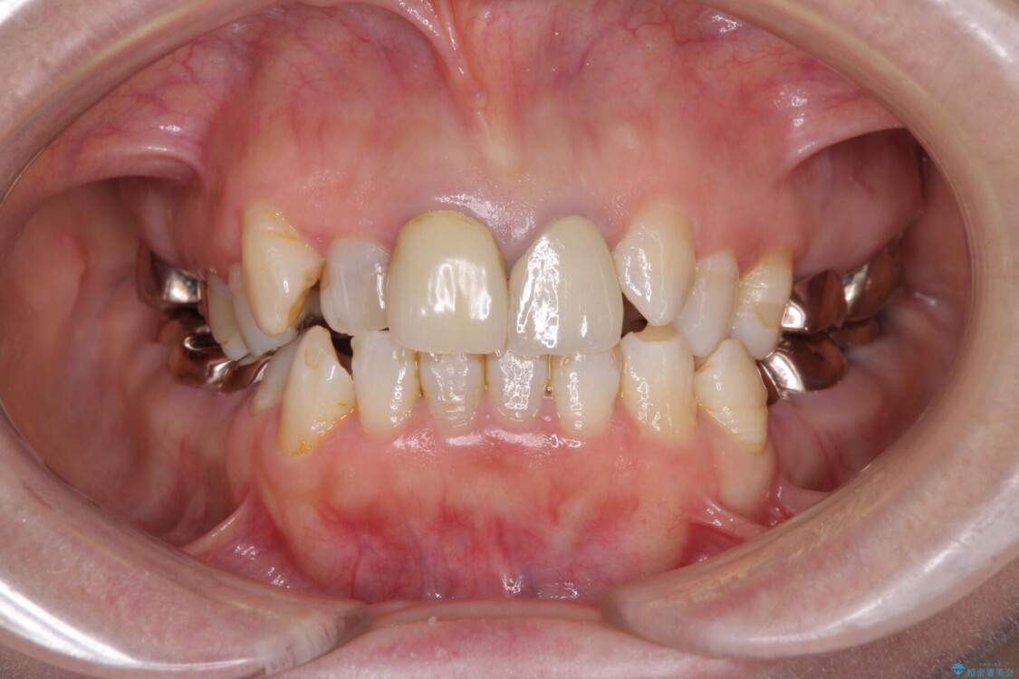 奥歯の銀歯と歯並びを改善　歯周外科治療と矯正治療を行った総合歯科診療 治療前