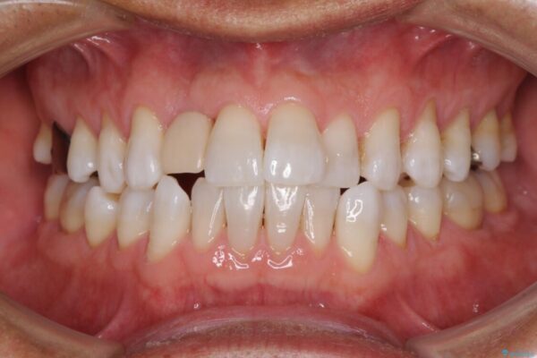 治療途中の前歯を治したい　インビザライン矯正とオールセラミッククラウン ビフォー