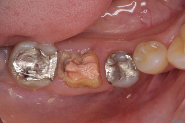 インプラントしかないと言われた　奥歯のオールセラミックブリッジ 治療前画像