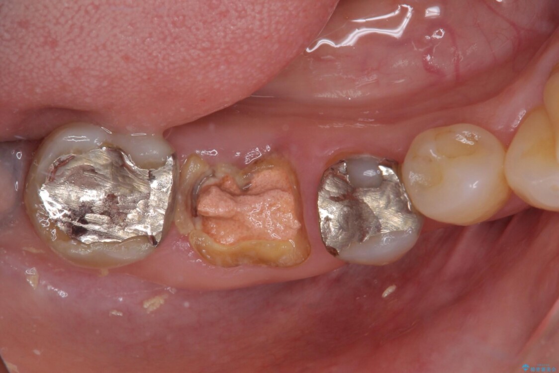 インプラントしかないと言われた　奥歯のオールセラミックブリッジ 治療前
