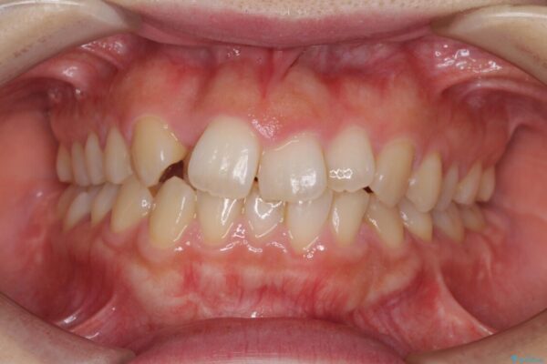 変則的な抜歯矯正　八重歯を抜いてしまった人のワイヤー矯正 ビフォー