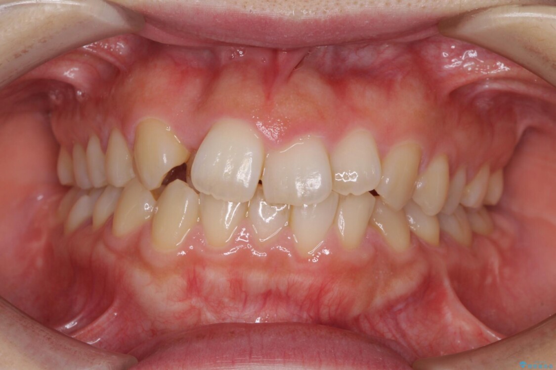 変則的な抜歯矯正　八重歯を抜いてしまった人のワイヤー矯正 治療前