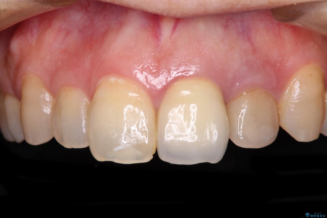 横から見た時の歯の色が違いすぎる　前歯のオールセラミッククラウン 治療前