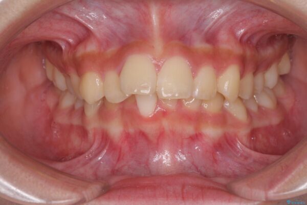 下の前歯が隠れてしまうほど深い咬み合わせ　高校生のインビザライン矯正治療 治療前画像