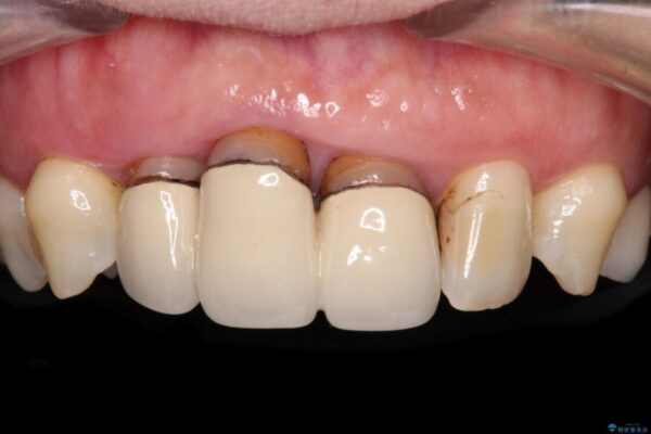 歯茎の縁に見える変色を隠したい　前歯のオールセラミッククラウン ビフォー
