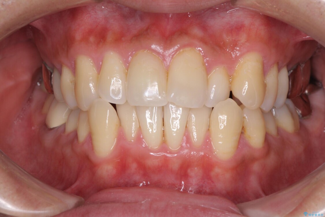 受け口傾向の咬み合わせ　前歯のデコボコをワイヤー矯正で素早く改善 治療前