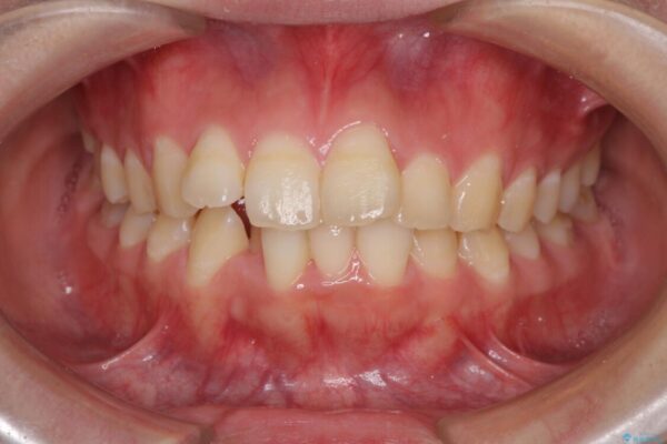 前歯の出っ歯と口の閉じにくさを抜歯矯正で改善　目立たないワイヤー矯正 治療前画像