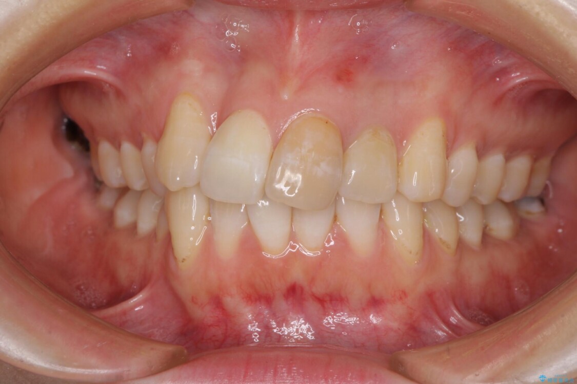 内側にある歯が邪魔　重なった前歯の歯列矯正 治療前