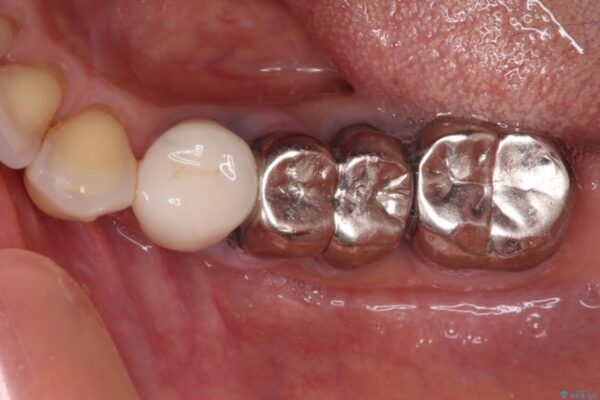 抜かずに保存した奥歯が痛くて臭う　セラミックブリッジによる欠損補綴治療 治療前画像