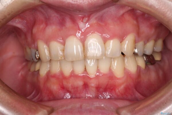 目立つ銀歯を白くしたい　奥歯のセラミック治療 治療前画像