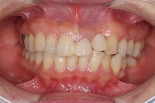 口元の突出感を治したい　治療中の歯も治したい ビフォー