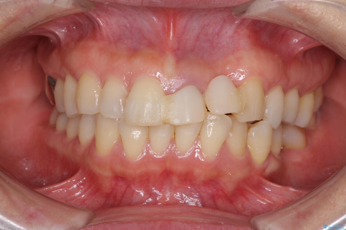 口元の突出感を治したい　治療中の歯も治したい 治療前