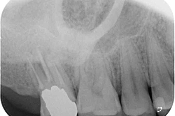 歯に穴を開けられてしまった　インプラントによる奥歯の補綴治療 治療前画像