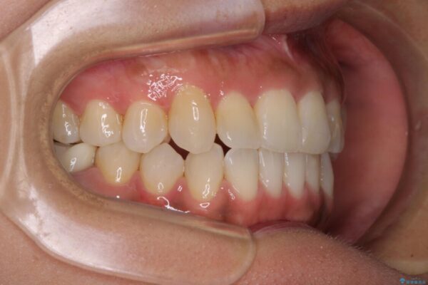 【モニター】幅の狭い上顎歯列　骨幅を拡大する矯正治療 治療後画像