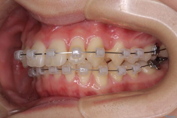 【モニター】犬歯のクロスバイトを目立たないワイヤー装置で 治療途中画像