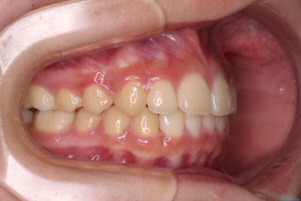 下の前歯が隠れてしまうほど深い咬み合わせ　高校生のインビザライン矯正治療 治療後画像