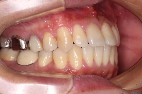 受け口傾向の咬み合わせ　前歯のデコボコをワイヤー矯正で素早く改善 治療後画像