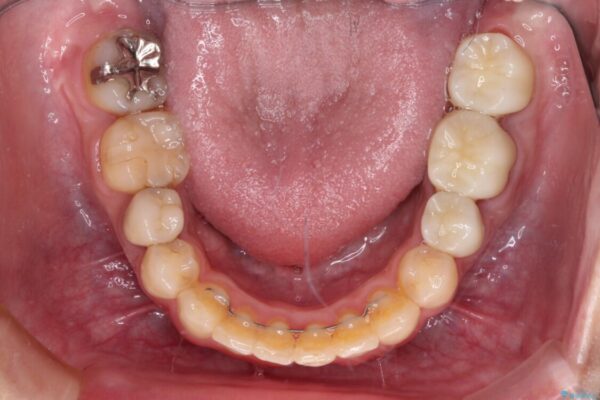 目立つ銀歯を白くしたい　奥歯のセラミック治療 治療後画像