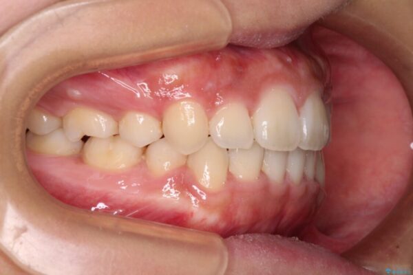 気になる八重歯を治したい　目立たないワイヤーでの抜歯矯正 治療後画像