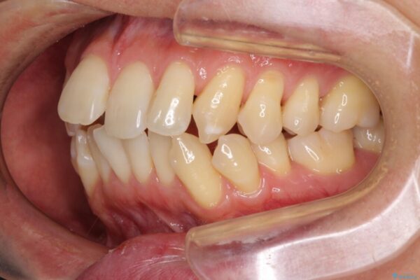 掃除しにくい前歯と閉じにくい口元　目立たないワイヤー装置での抜歯矯正 治療前画像