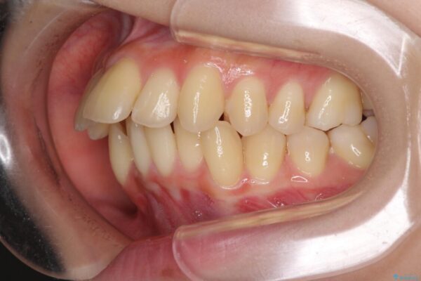 出っ歯を治したい　ワイヤー装置による抜歯矯正 治療前画像