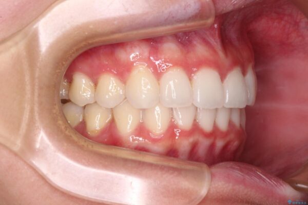 飛び出した前歯と黄ばんだ歯　ホワイトニングしながらマウスピース矯正 治療後画像