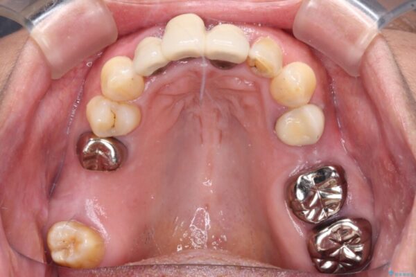 歯茎の縁に見える変色を隠したい　前歯のオールセラミッククラウン 治療前画像