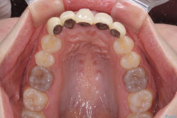 不揃いな前歯のセラミックが気になる　オールセラミッククラウンによる補綴治療 治療前画像