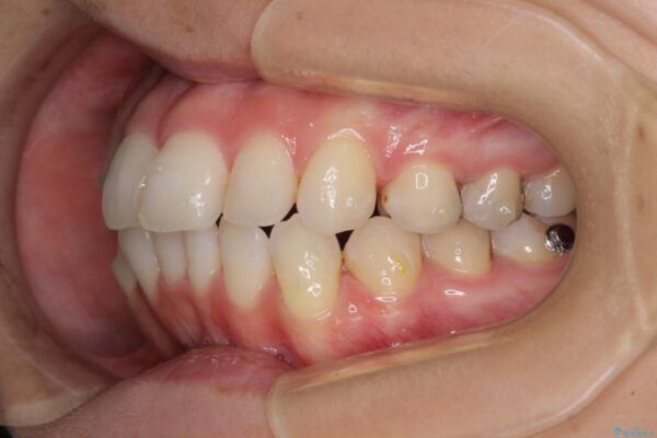 【モニター】前歯のデコボコをインビザラインできれいに整える 治療途中画像
