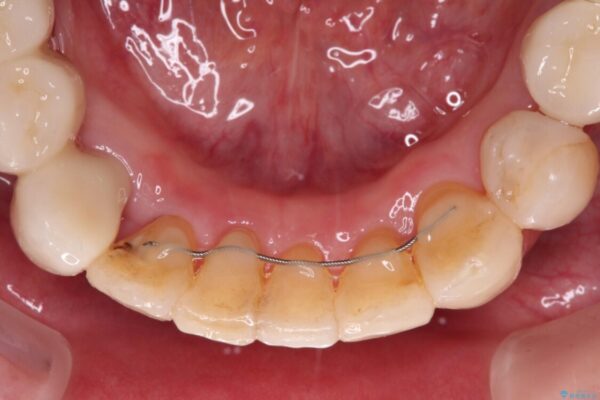 歯並びや奥歯の痛み　色々と治したい　総合歯科診療 治療後画像