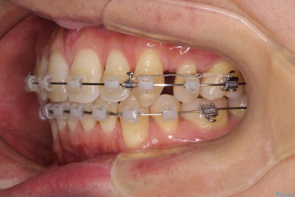 掃除しにくい前歯と閉じにくい口元　目立たないワイヤー装置での抜歯矯正 治療途中画像
