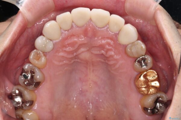 テトラサイクリン歯をオールセラミッククラウンで審美的に 治療後画像