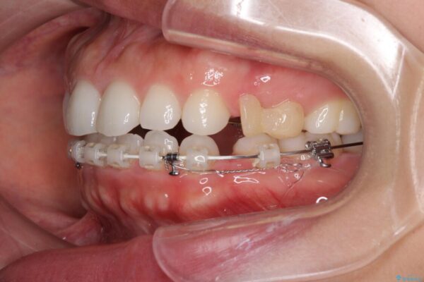 目立たない装置で横顔のシルエットを改善　ハーフリンガルでの抜歯矯正 治療途中画像