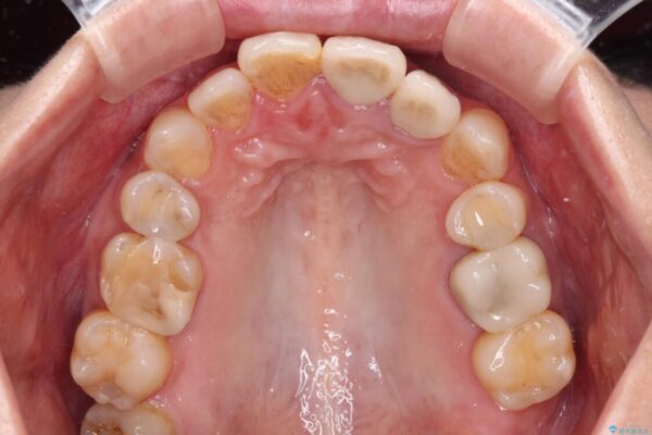 横から見た時の歯の色が違いすぎる　前歯のオールセラミッククラウン 治療後画像