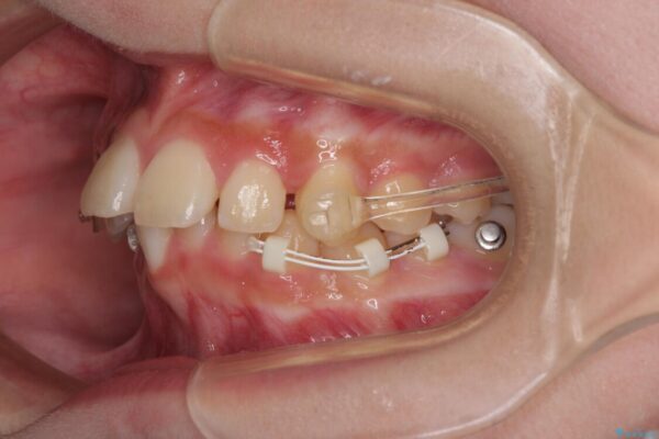 下の前歯が隠れてしまうほど深い咬み合わせ　高校生のインビザライン矯正治療 治療途中画像